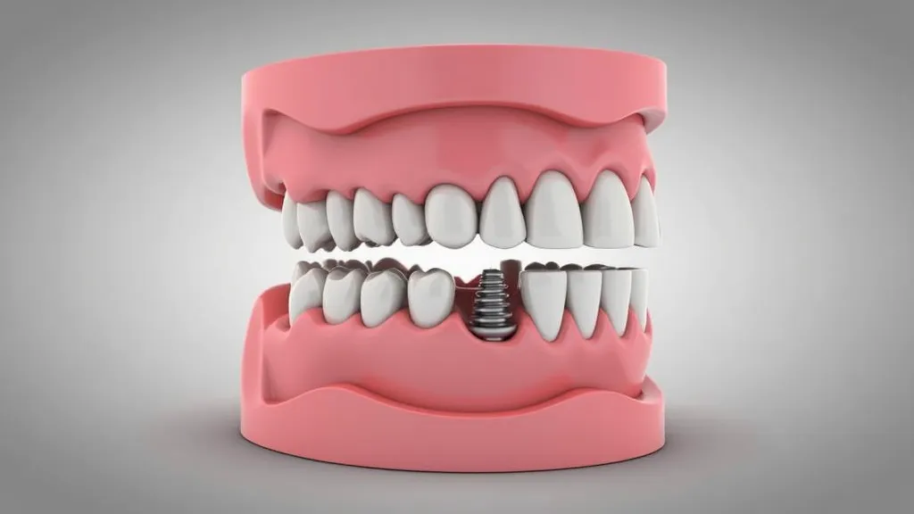 Affordable Full Mouth Dental Implants