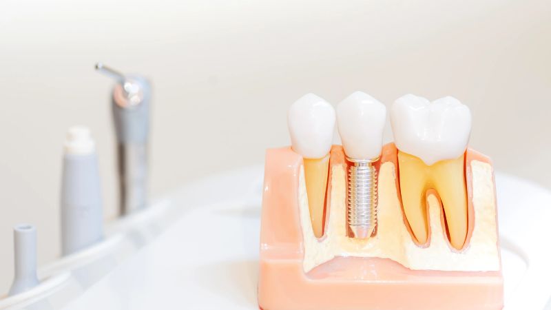 歯の喪失と歯科インプラントで咬合機能を取り戻す