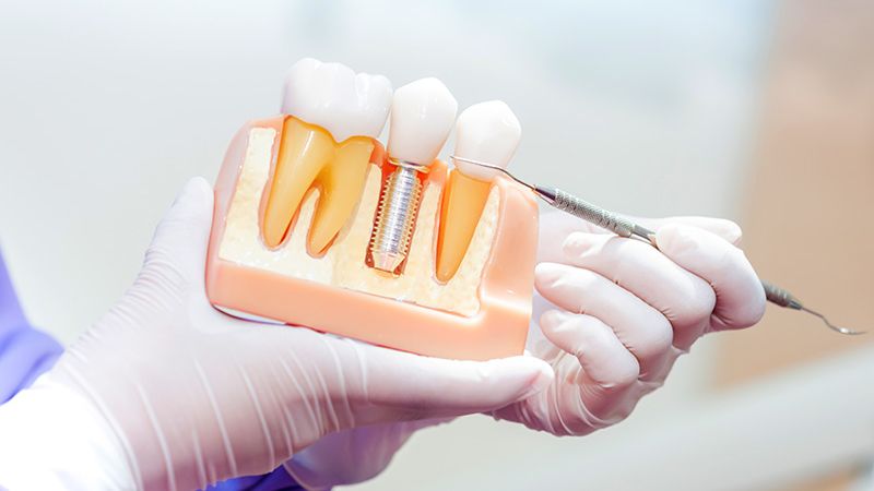 美しい笑顔のための歯科ルールと矯正器ガイド