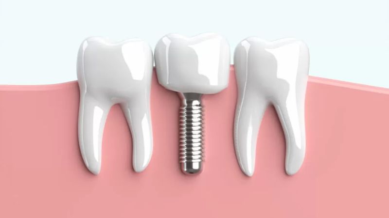 東京の衝撃価格!高品質でリーズナブルな歯科インプラントへのアクセス