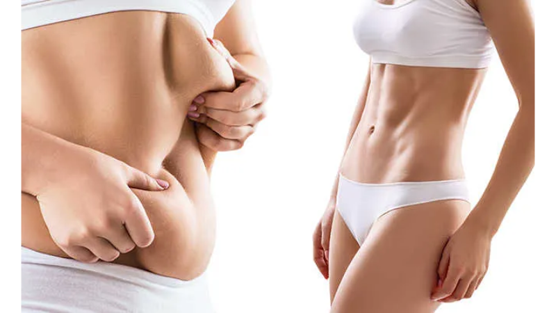 Entendendo a Abdominoplastia Estética