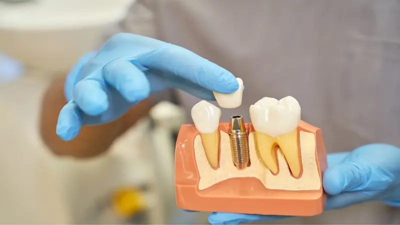 Affordable Dental Implants and Medicare Solutions