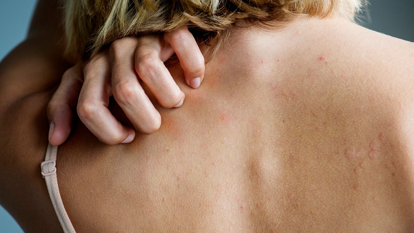 Understanding Plaque Psoriasis: Detection and Treatment Guide